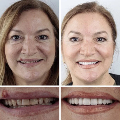 Ends Today: 70% OFF! ⏰ Medical Full Denture with Strong Suctiond🦷