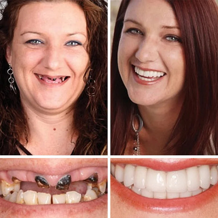 Ends Today: 70% OFF! ⏰ Medical Full Denture with Strong Suctiond🦷